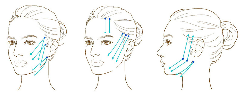 糸リフトの刺入方法