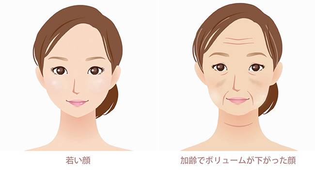 加齢による顔のたるみ