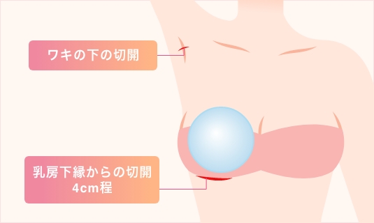シリコンバッグ豊胸の切開部位についての解説したイラスト