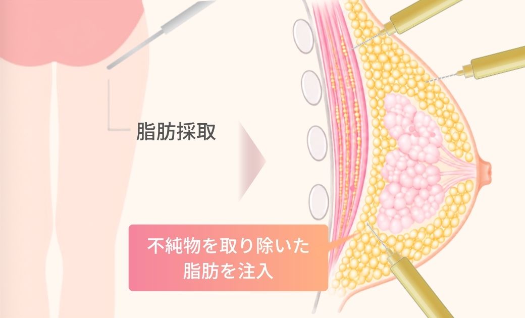 コンデンスリッチ(脂肪注入)豊胸の仕組みを説明したイラスト