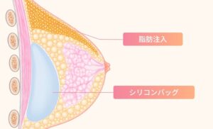 ハイブリッド豊胸の図解