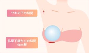 シリコンバッグ豊胸の図解