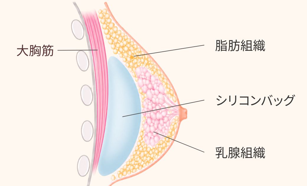 オーキッド美容クリニック東京御徒町におけるシリコンバッグ豊胸（乳腺下）の図解